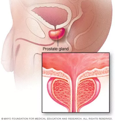 Prostate Cancer in a Nutshell