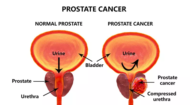 Prostate Cancer in a Nutshell